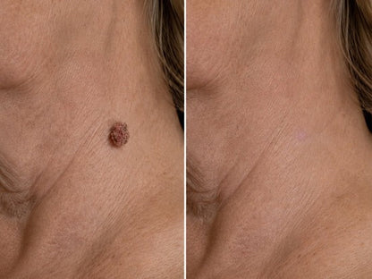 ✨Hiskin ® 2-in-1 Microneedle & Hydrocolloid Patch🍀 | Removes raised moles, acne, flat warts, and skin tags | Helps improve wrinkles, scars, and blemishes | Invisible patches for face and body