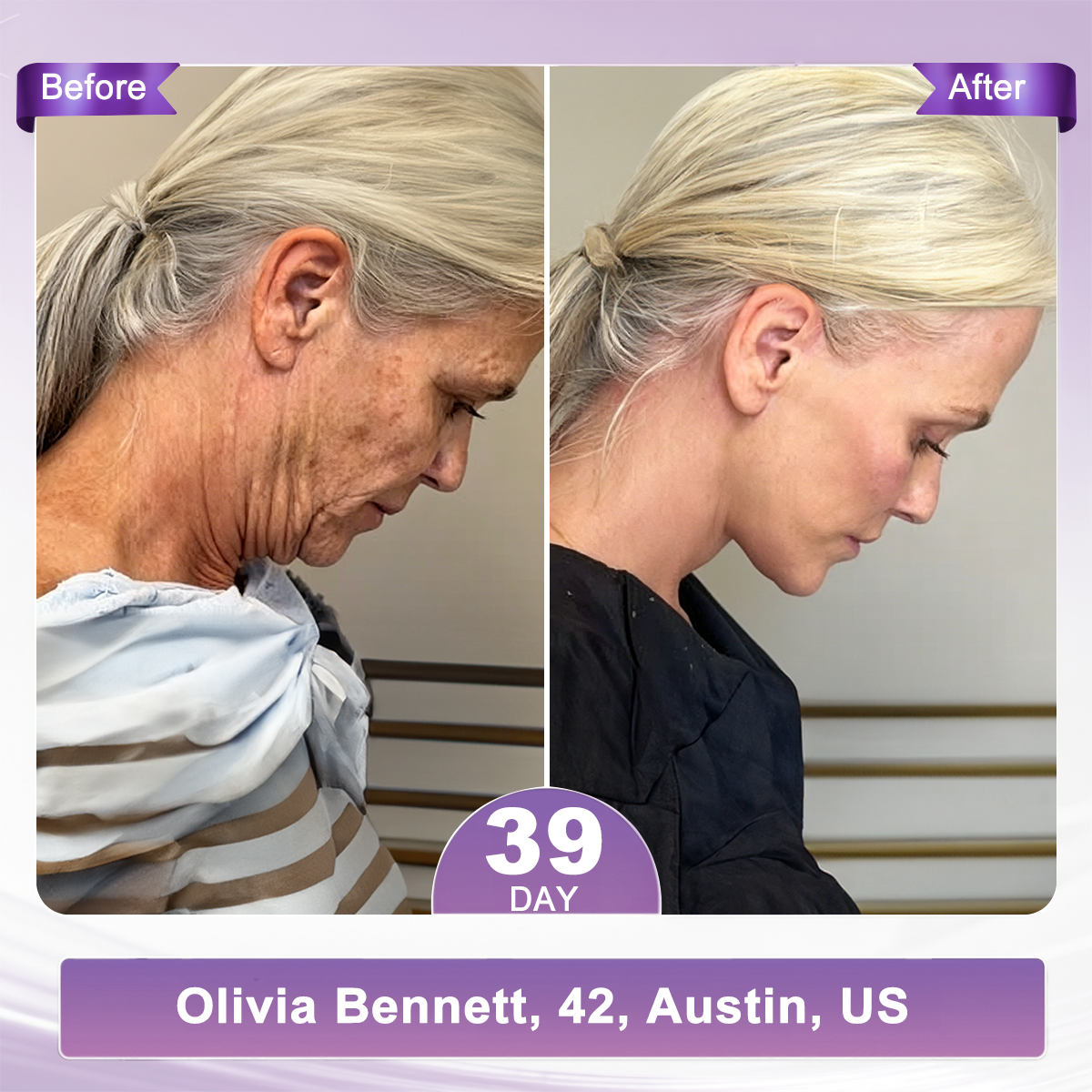 FDA Official: 𝐇𝐈𝐒𝐊𝐈𝐍® 𝐏𝐃𝐑𝐍 𝐌𝐮𝐥𝐭𝐢-𝐏𝐞𝐩𝐭𝐢𝐝𝐞 𝐌𝐚𝐬𝐬𝐚𝐠𝐢𝐧𝐠 𝐁𝐨𝐝𝐲 𝐑𝐨𝐥𝐥𝐞𝐫 𝐂𝐫𝐞𝐚𝐦- Anti-aging, Hydrating, Skin Firming & Lifting, Skin Repair, Even Tone, Acne and Dark Spot Treatment, Wart and Mole Removal, and Psoriasis Relief.